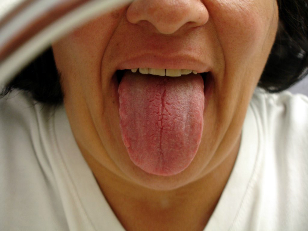 cracked tongue causes